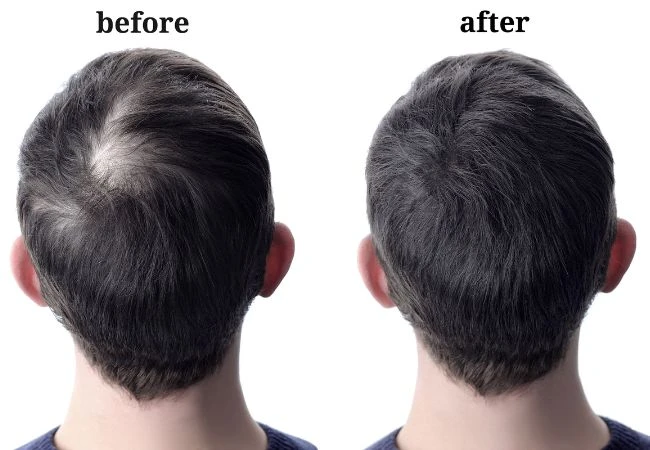 Hair Patch For Men