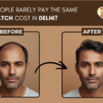 wo People Rarely Pay the Same For Hair Patch Cost In Delhi