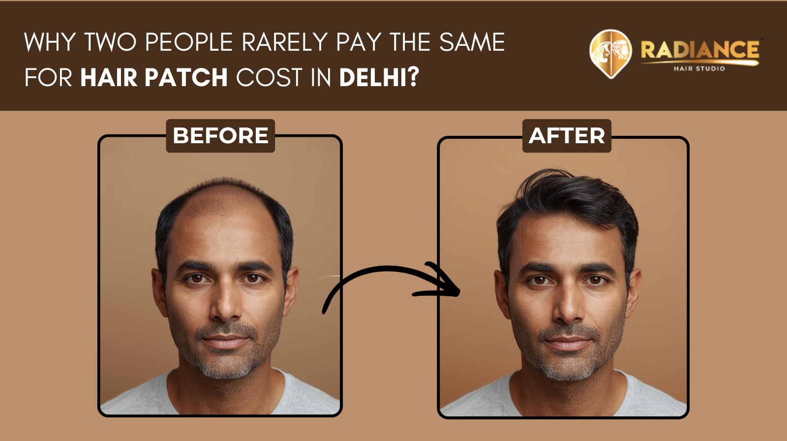 wo People Rarely Pay the Same For Hair Patch Cost In Delhi